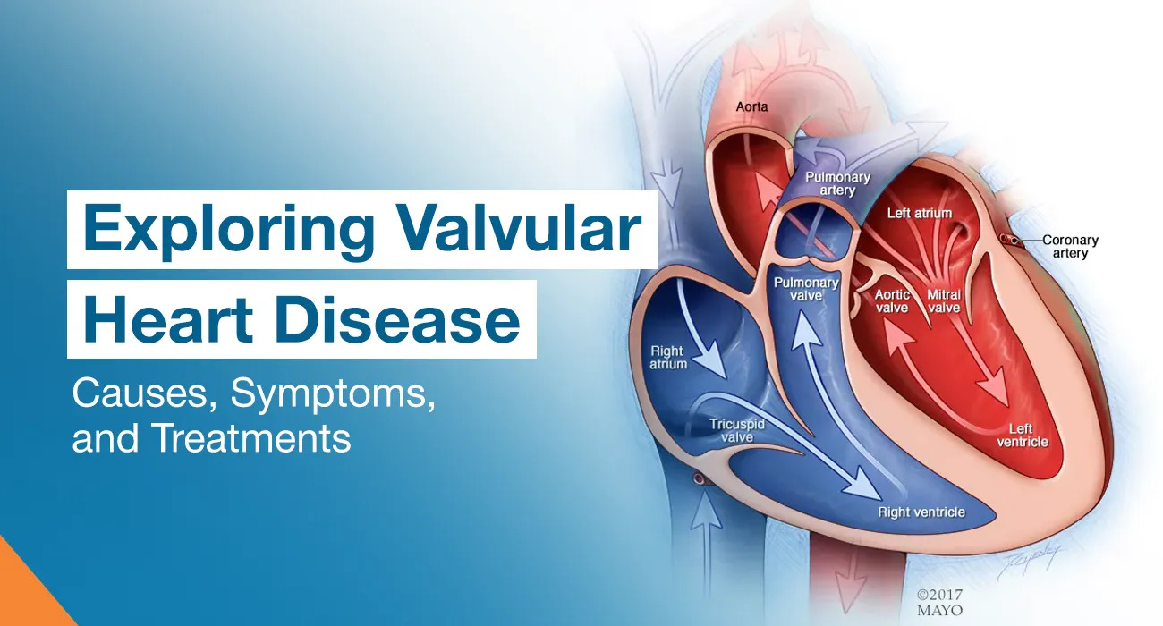 Exploring Valvular Heart Disease: Causes, Symptoms, and Treatments